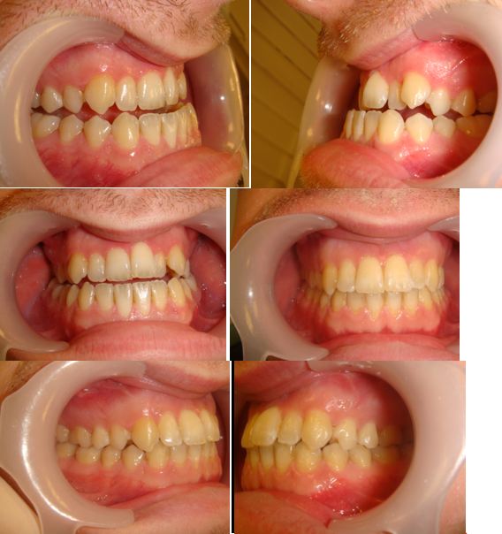 This Adult Patient completed treatment in 12 months