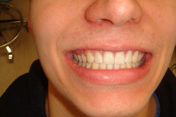 invisalign-behandling2.jpg